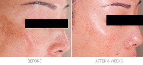 Generalized Melasma